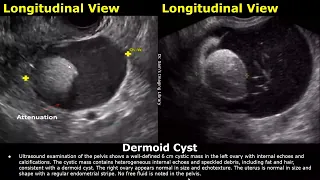 Ovary Ultrasound Reporting | Ovarian Diseases Scan Reports | How To Write USG Report | Pelvic USG