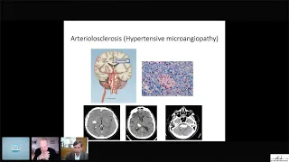 Cerebral Amyloid Angiopathy - Diagnosis & Treatment