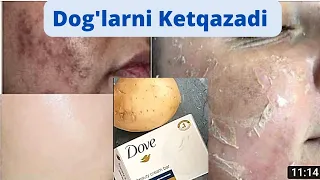 YUZDAGI DOG'LARNI KETKAZISH, OQARTIRISH. Tasirchan yuzlar sinovdan keyin/ ОТБЕЛИВАНИЕ ПЯТЕН НА ЛИЦЕ