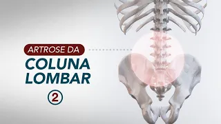 Artrose da coluna lombar: tratamento