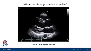 HCM Microlesson Case Example #2: HCM versus Athlete's Heart