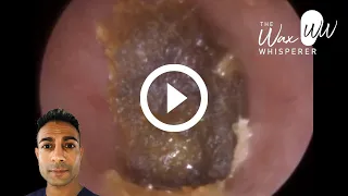 983 - Tightly Compressed Ear Wax Removal