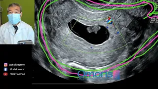 Missed Abortion - 9 Weeks