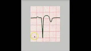 PATHOLOGIC Q WAVE