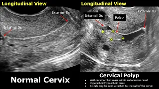 Cervix Ultrasound Normal Vs Abnormal Image Appearances | Uterus Pathologies | Gynecological USG