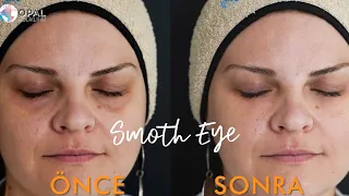 Fotona Smooth Eye Uygulaması I Dr. Ferda Karataş