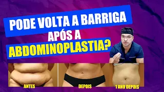 QUEM FAZ ABDOMINOPLASTIA PODE VOLTAR A TER BARRIGA? I Cirurgia Plástica