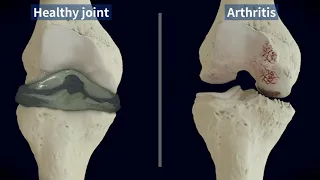 What does knee arthritis look like?