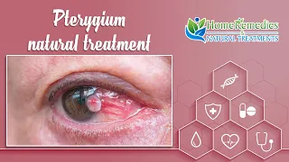 Pterygium Eye (Surfer's Eye) Home Natural Treatment | Pterygium Treatment Without Surgery