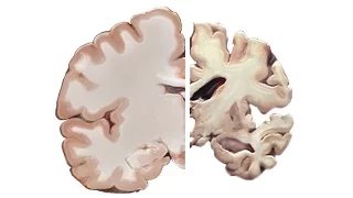 Alzheimer's and the Brain