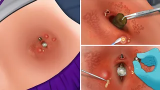 Best treatment Umbilical stone removal animation - umbilical stone | 탯줄 돌 제거 애니메이션 - 배꼽 돌