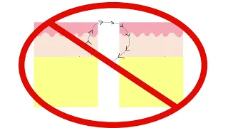 How to suture like a plastic surgeon: Lesson 7 - Deep dermal sutures