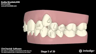 Invisalign Patients Before and After: Nirenblatt Orthodontics