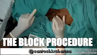 #PNS GUIDED SUPRACLAVICULAR NERVE BLOCK #PLUMB BOB TECHNIQUE