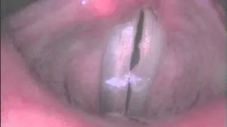 33 - vocal fold poly - post - ROVD
