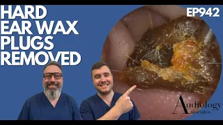 HARD EAR WAX PLUGS REMOVED - EP942