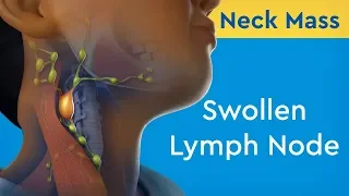 Neck Mass: Swollen Lymph Node
