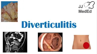 Diverticulitis: Risk Factors (ex. Low Fiber Diets), Symptoms, Diagnosis, Treatment and Complications