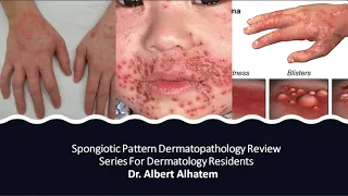 Dermatopathology Lesson 1- Spongiotic Dermatitis (Tissue Reaction Patterns)