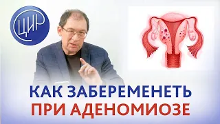 Аденомиоз. Возможна ли беременность при аденомиозе 2 степени? Отвечает Гузов И.И.