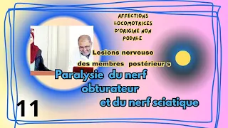 paralysie du nerf obturateur et du nerf sciatique ,dg ,symptômes