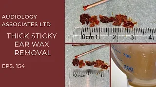 THICK STICKY EAR WAX REMOVAL - EP 154