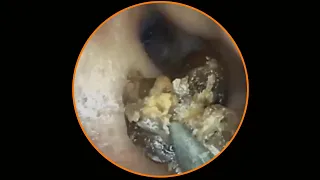 Ear Wax Removal Take Care of Your Ears | P 113