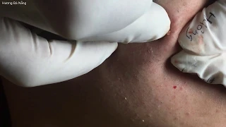 Pimple popper blackhead (film by myself) | 24/03/2020 | Acne treatment Hương Đà Nẵng