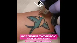 Удаление тату лазером Picosure. Москва. Клиника косметологии и пластической хирургии Vip Clinic.