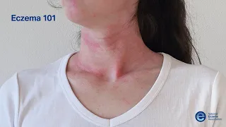 Eczema 101