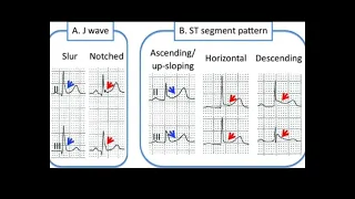 High risk features of Benign early repolarization pattern on ECG