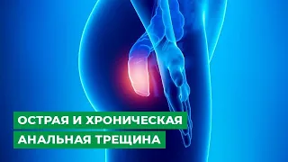 Острая и хроническая анальная трещина. Лечение или операция?