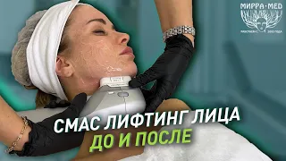 СМАС ЛИФТИНГ ЛИЦА ДО И ПОСЛЕ / SMAS Ultraphormer