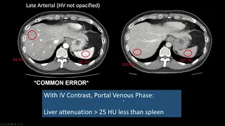 Interpreting CT Abdo: Background Liver, Hepatic Steatosis, High Attenuation Liver