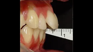 Non Surgical Orthodontic treatment of Skeletal Class II with (7mm) Over-jet