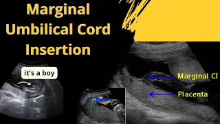 Ultrasound showing boy baby !!! with Marginal Umbilical Cord Insertion type!