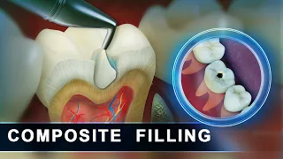 Composite Filling | Molar Cavity Filling with Composite | Advance 3D Dental Animation