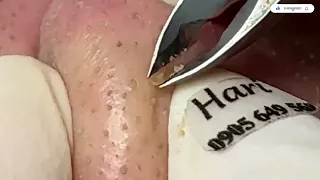 Blackheads Removal from the Nose with Hari's - Satisfying