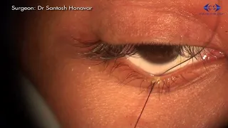 Eyelid Retraction Correction Transonjunctival Approach