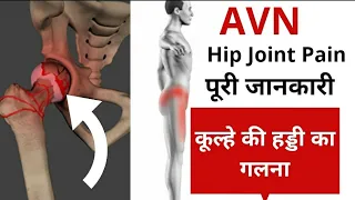AVN of Hip Joint| कूल्हे की हड्डी का गलना या घिस जाना | Dr.Dushyant |