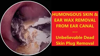 HUMONGOUS SKIN & EAR WAX REMOVAL FROM EAR CANAL - EP70 #relaxing #satisfying #asmr