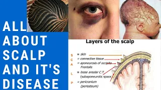 Understand whole concept of SCALP along with it's disease|BLACKEYE|CAPUT SUCCEDANEUM|CEPHAL HEMATOMA