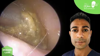 1,228 - Tight Squeeze Ear Wax & Dead Skin Removal