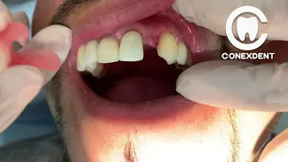 Prótesis Flexible  de 1 diente (SMILING CONEXDENT )