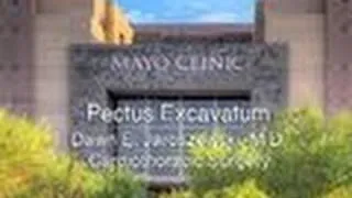 Pectus Excavatum Surgery - Mayo Clinic