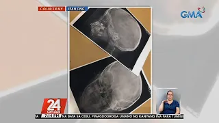 Baterya, pumasok sa ilong ng 3-anyos na lalaki | 24 Oras