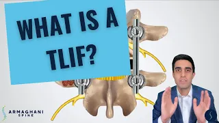 How I perform a TLIF (and what to expect after)