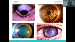 Keratoconus - Overview #WorldKeratoconusDay