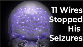 Epilepsy patient's seizures and the medical science that saved him.