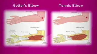 Golfer's Elbow vs. Tennis Elbow